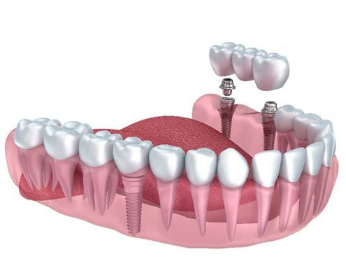 same-day-crowns http://smilewide.in/wp-content/uploads/2017/12/same-day-crowns.jpg