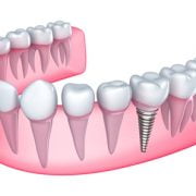 dental-crowns-ahwatukee-az