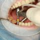 dental implants zirakpur