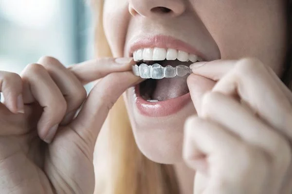 Dental braces and aligners in Zirakpur — SmileWide orthodontist