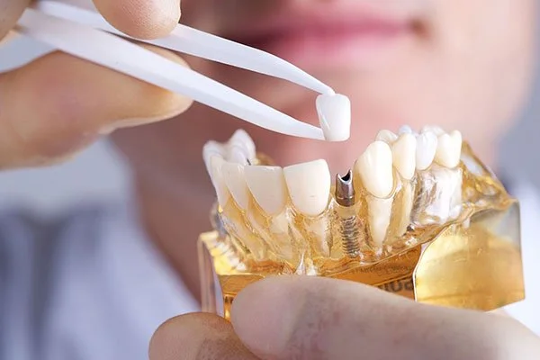 Dental implants in Zirakpur by certified implantologist — SmileWide