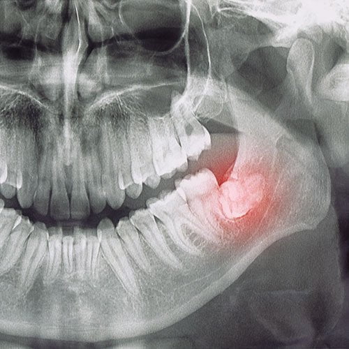 Common causes of toothache