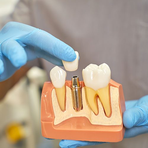 Alternative to root canal treatment Alternative to root canal treatment