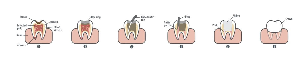 Root Canals Treatment Process Root Canals Treatment Process