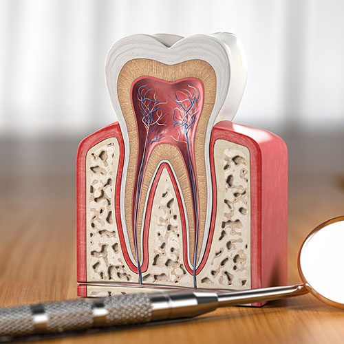 Root Canals Treatment in Zirakpur