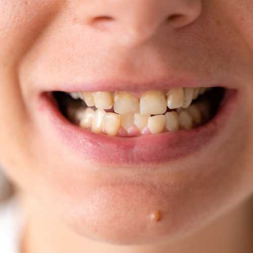 Symptoms you need dental braces
