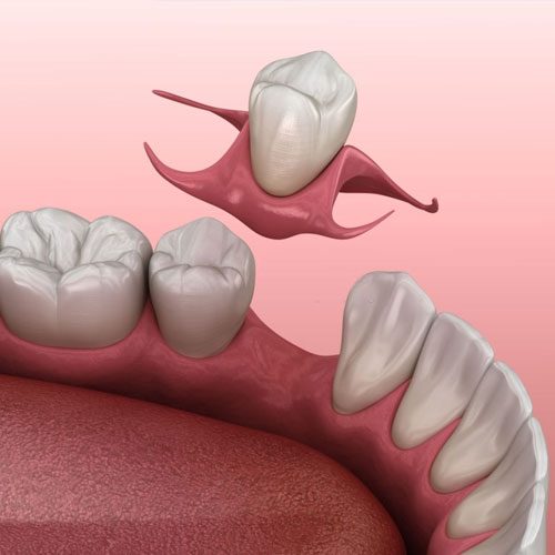 Immediate dentures in Zrakpur