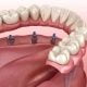 Implant Supported Dentures in Zirakpur