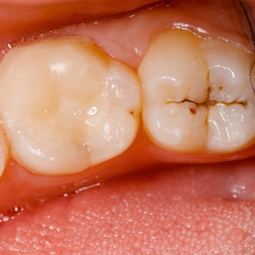 Tooth-Cavities