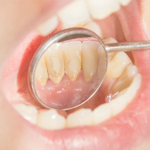 teeth-plague-cleaning