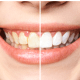 Teeth Discoloration