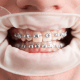 Image of an adult smiling confidently with braces, showcasing the effectiveness of orthodontic treatment for grown-ups.