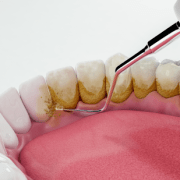 “Understanding Dental Plaque: Causes, Effects, and Prevention Close-up of teeth covered in dental plaque, highlighting the yellowish, sticky buildup on the tooth surfaces.