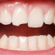 Image of a person with a chipped tooth
