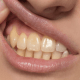 "Close-up of a female discolored teeth, showing significant yellow staining."