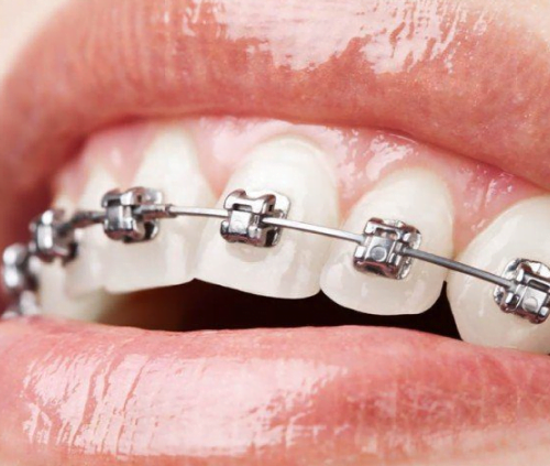 The pros and cons of dental braces