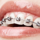 The pros and cons of dental braces