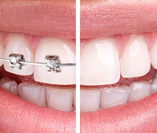 Types of Different braces