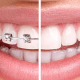 Types of Different braces