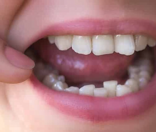 How Tooth Overcrowding Happens