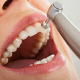 what to expect during a dental cleaning