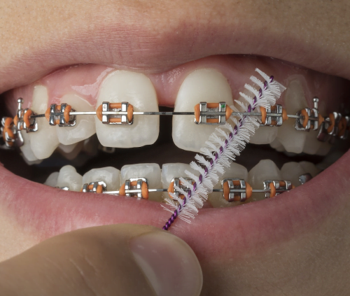 Orthodontic Options for Correcting Bite Issues
