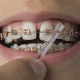 Orthodontic Options for Correcting Bite Issues