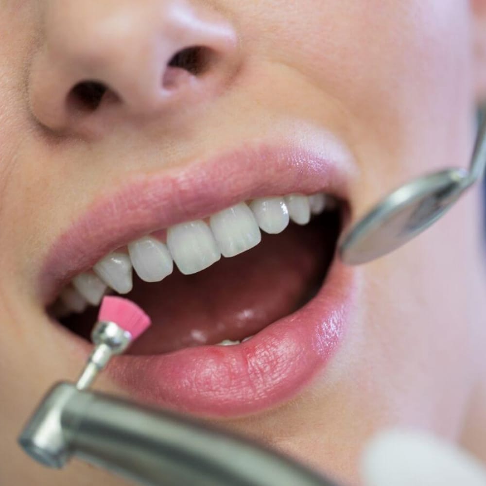 The Importance of Dental Scaling