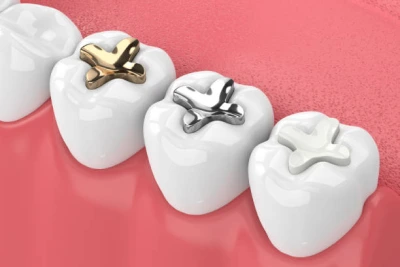 Composite fillings, or tooth-colored fillings