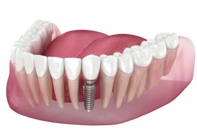 Dental Implants (Restoration & Placement)