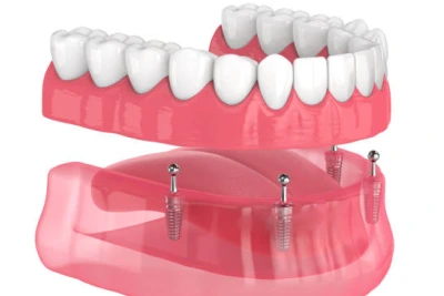 Dentures Supported By Implants