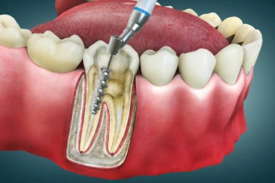 Root Canal Treatment