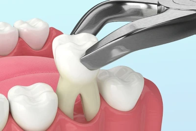Simple And Surgical Teeth Extractions