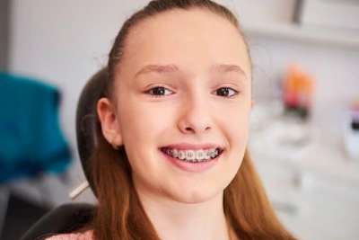 Braces made of ceramic