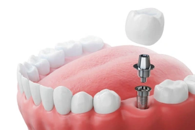 Dental Implant Surgery