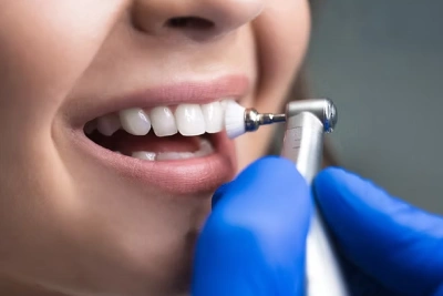 Expert Dental Cleaning (Preventive)