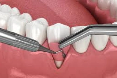 Gum Graft Procedures