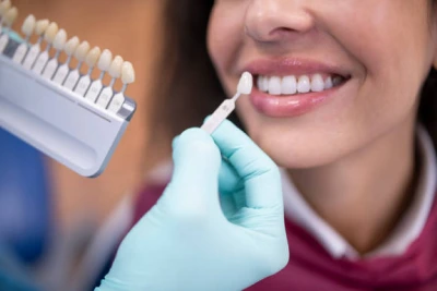 Porcelain and composite dental veneers