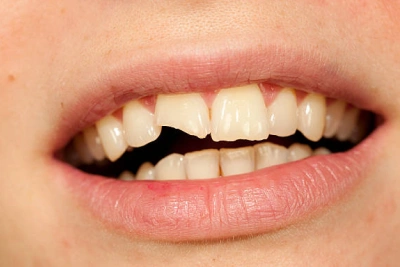 Repairing Broken or Chipped Teeth