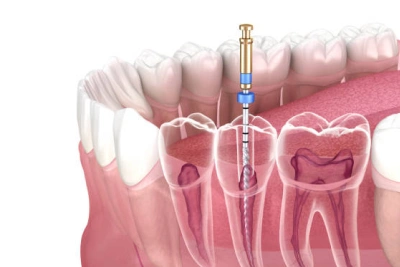 Root Canal Emergency