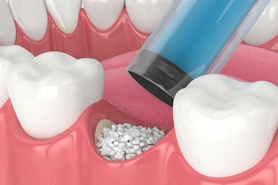 Sinus Lifts and Bone Grafting