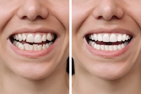 Before After Patient 1