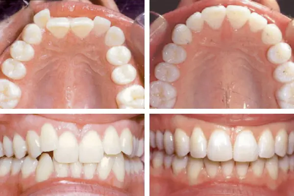 Before After Patient 2