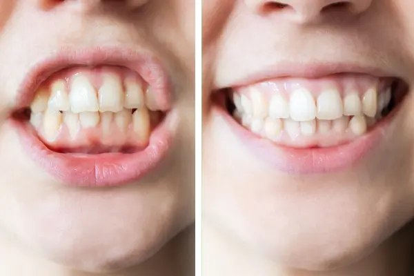 Before After Patient 3