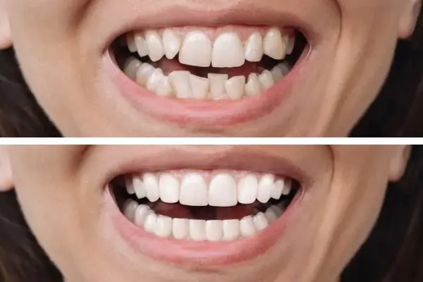 Before After Patient 4