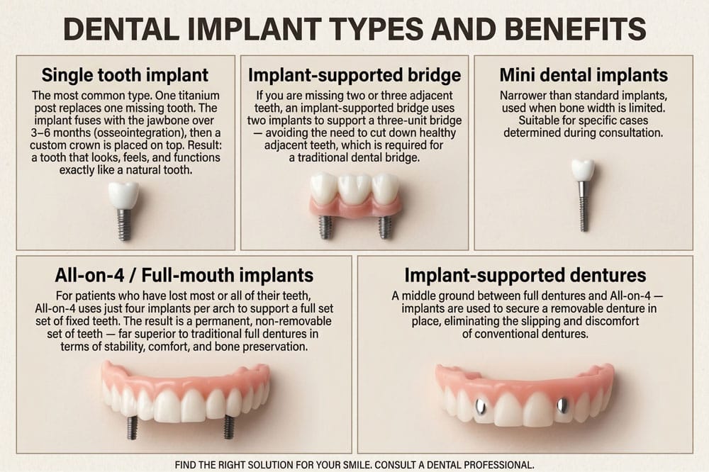 Types of Dental Implants & Cost - SmileWIde Dental Clinic Zirakpur
