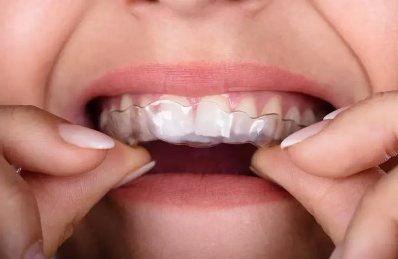 Why Choose Aligners SmileWide